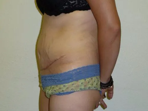 Tummy Tuck patient 3, after