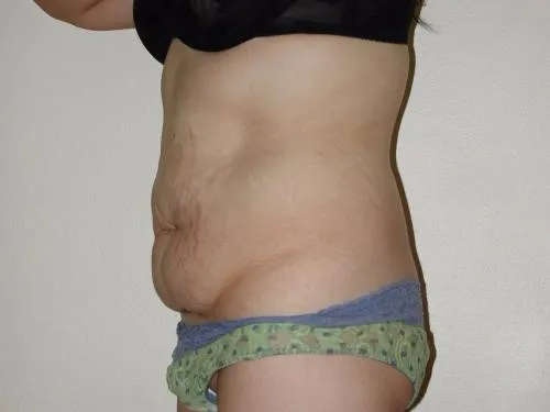Tummy Tuck patient 3, before