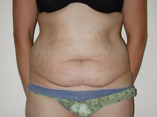 Tummy Tuck patient 3, before