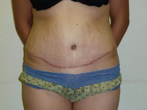 Tummy Tuck patient 3, after