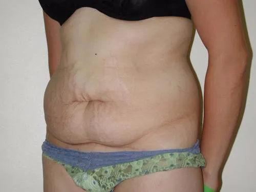 Tummy Tuck patient 3, before