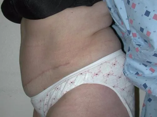 Tummy Tuck patient 2, after