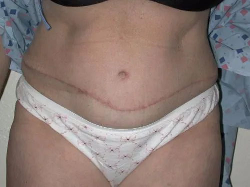 Tummy Tuck patient 2, after