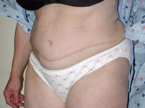Tummy Tuck patient 2, after