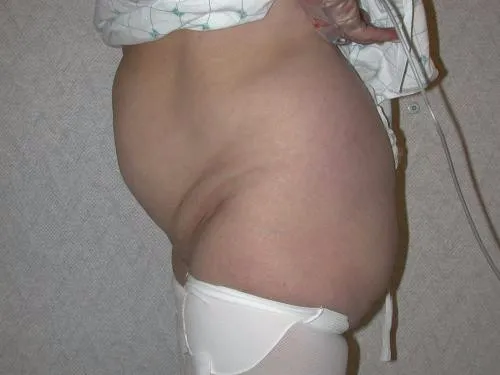 Tummy Tuck patient 2, before