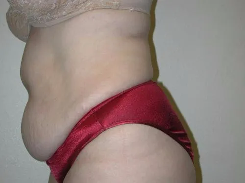 Tummy Tuck patient 1, before