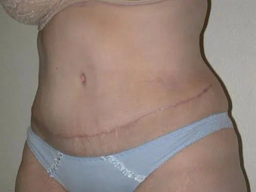 Tummy Tuck patient 1, after