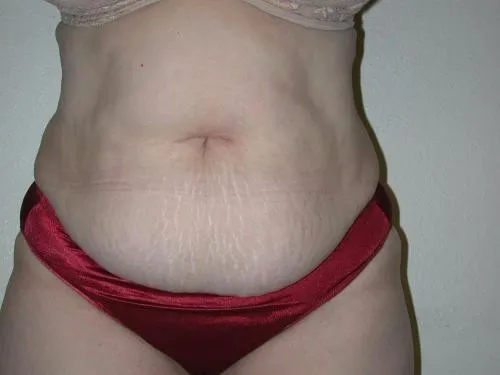 Tummy Tuck patient 1, before