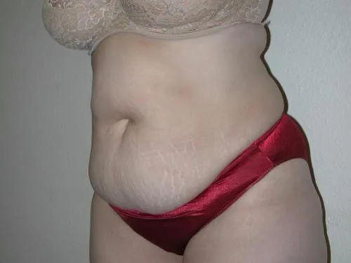 Tummy Tuck patient 1, before