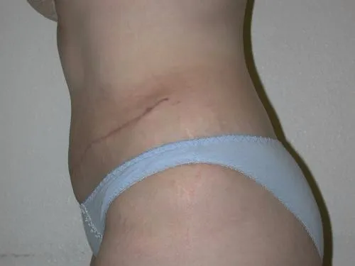 Tummy Tuck patient 1, after