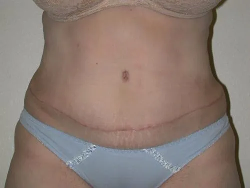 Tummy Tuck patient 1, after