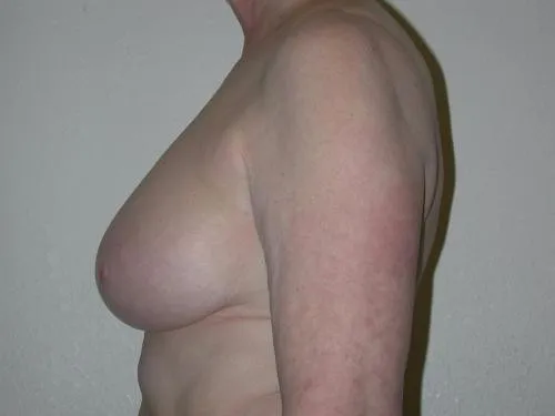 Breast Reconstruction patient 5, after