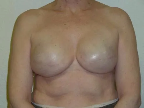 Breast Reconstruction patient 5, before