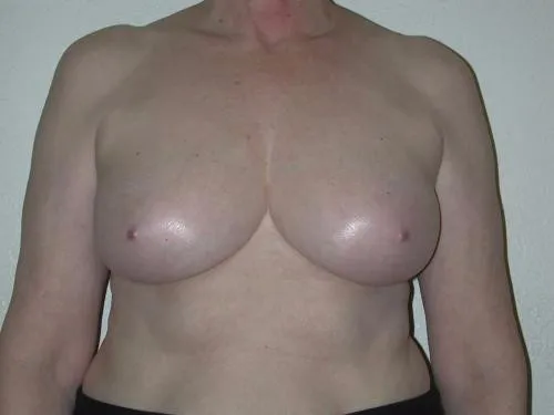Breast Reconstruction patient 5, after