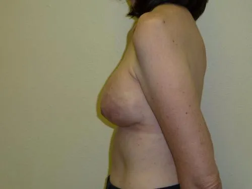 Breast Reconstruction patient 7, before