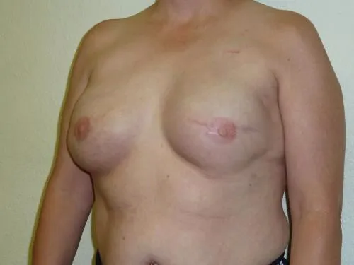 Breast Reconstruction patient 2, before