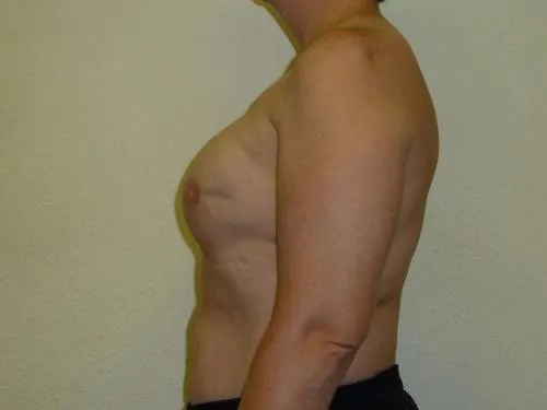 Breast Reconstruction patient 2, before
