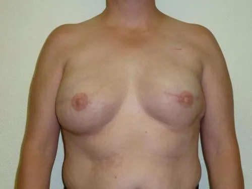 Breast Reconstruction patient 2, before
