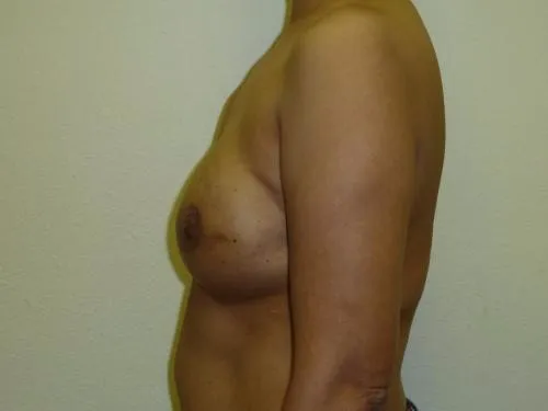 Breast Reconstruction patient 3, before