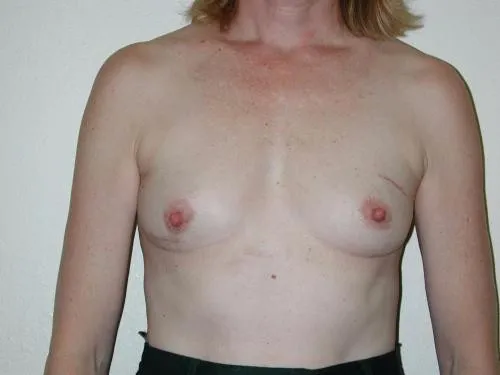 Breast Reconstruction patient 4, after