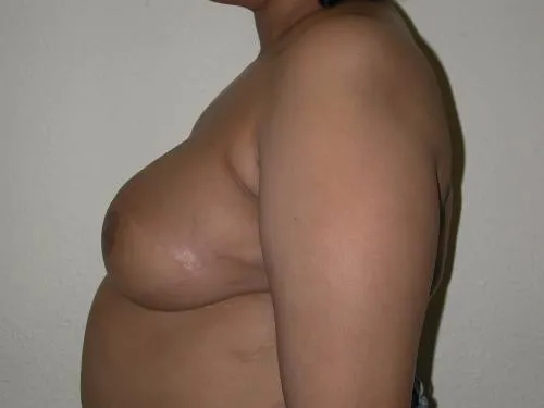 Breast Reconstruction patient 6, after