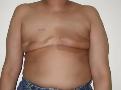Breast Reconstruction patient 6, before