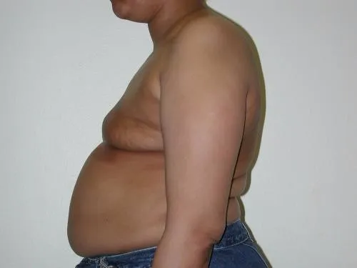 Breast Reconstruction patient 6, before