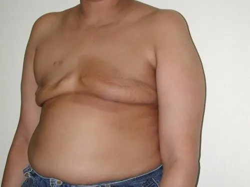 Breast Reconstruction patient 6, before