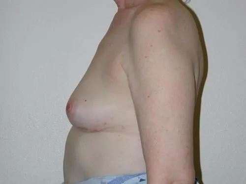 Breast Reconstruction patient 8, after