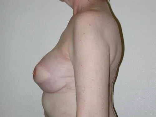 Breast Reconstruction patient 8, before
