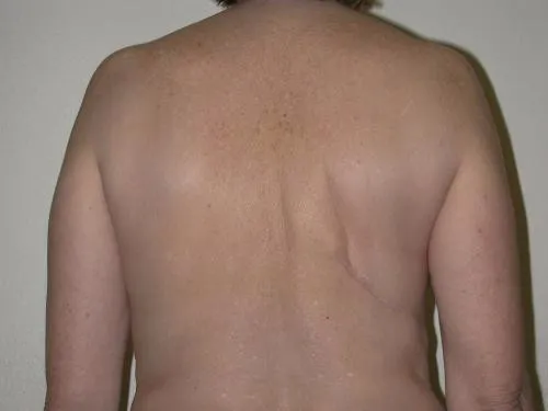 Breast Reconstruction patient 9, before