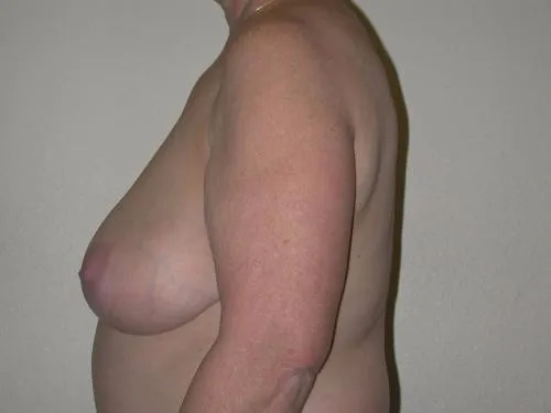 Breast Lift patient 1, before