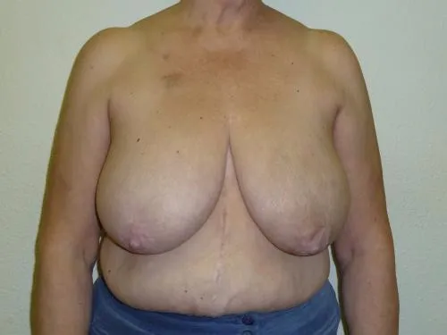 Breast Reduction patient 1, before