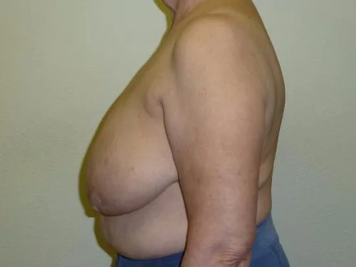 Breast Reduction patient 1, before