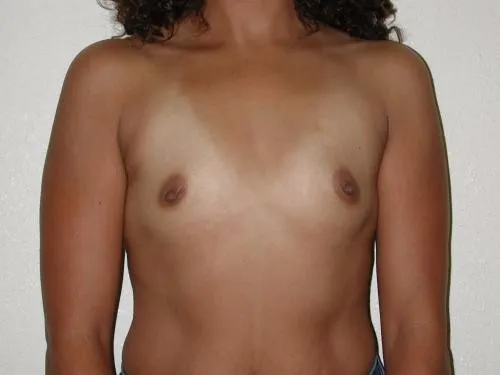 Breast Augmentation patient 7, before