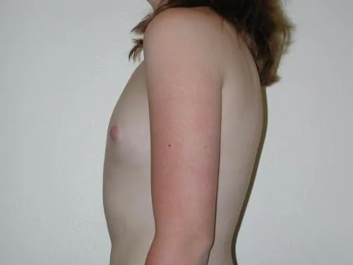 Breast Augmentation patient 3, before