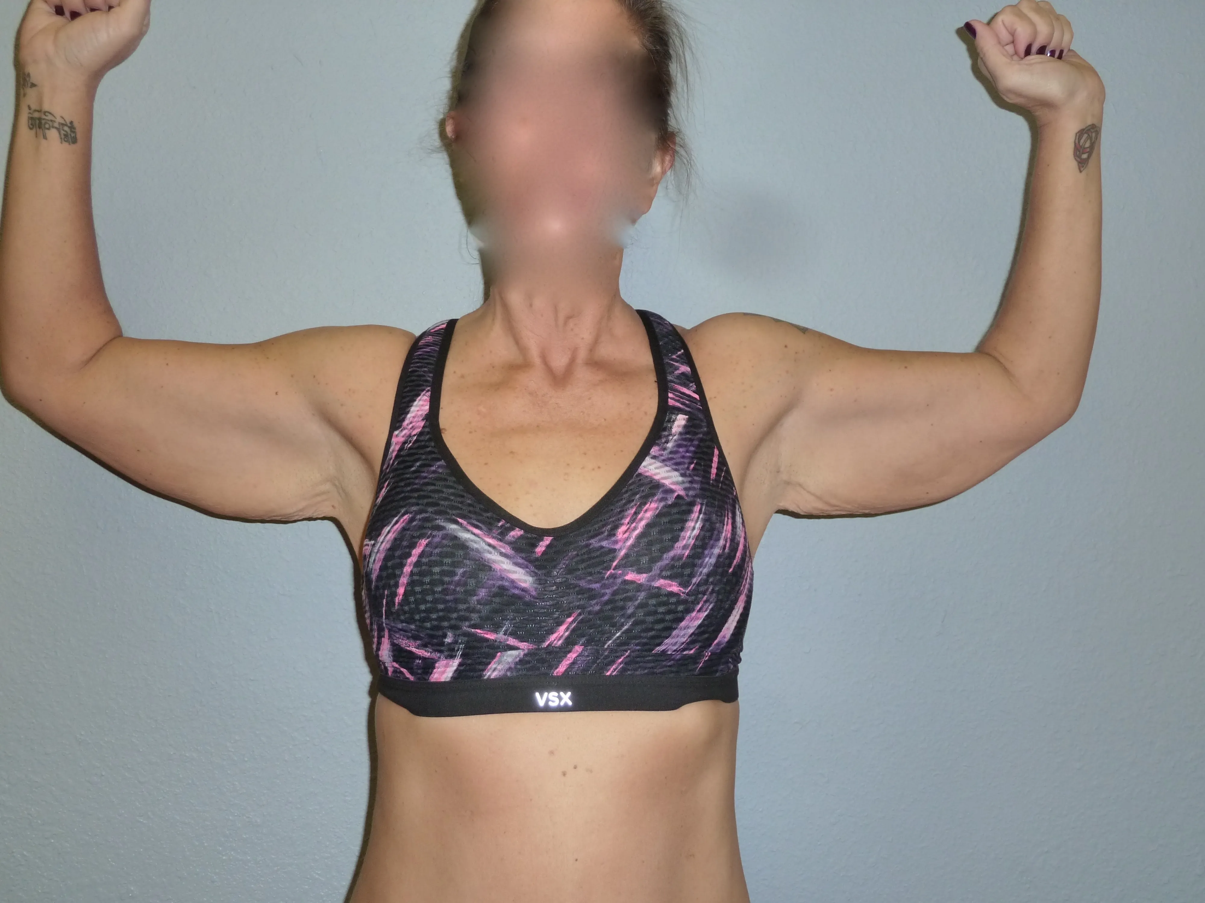 Arm Lift patient 1, before