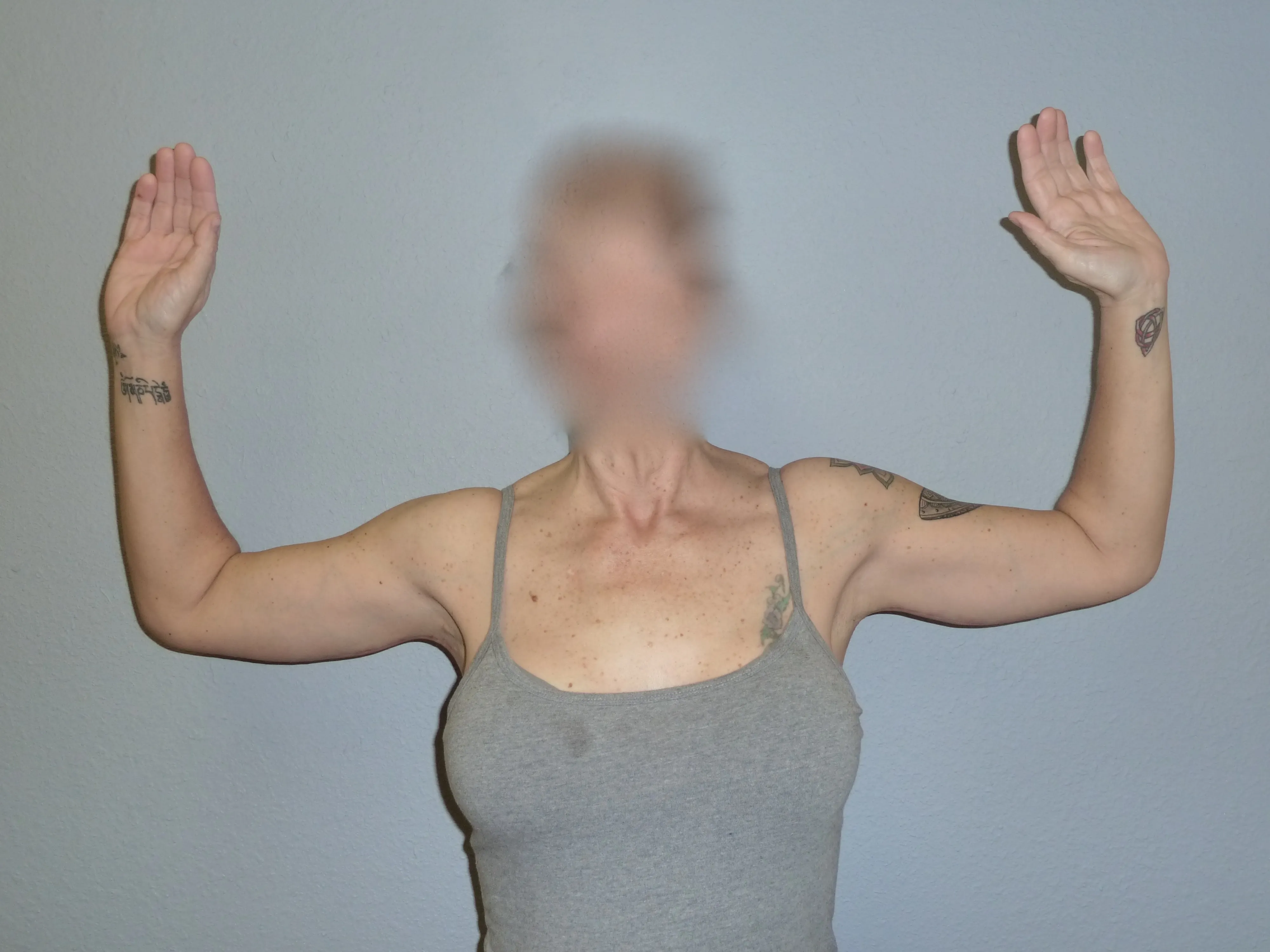 Arm Lift patient 1, after