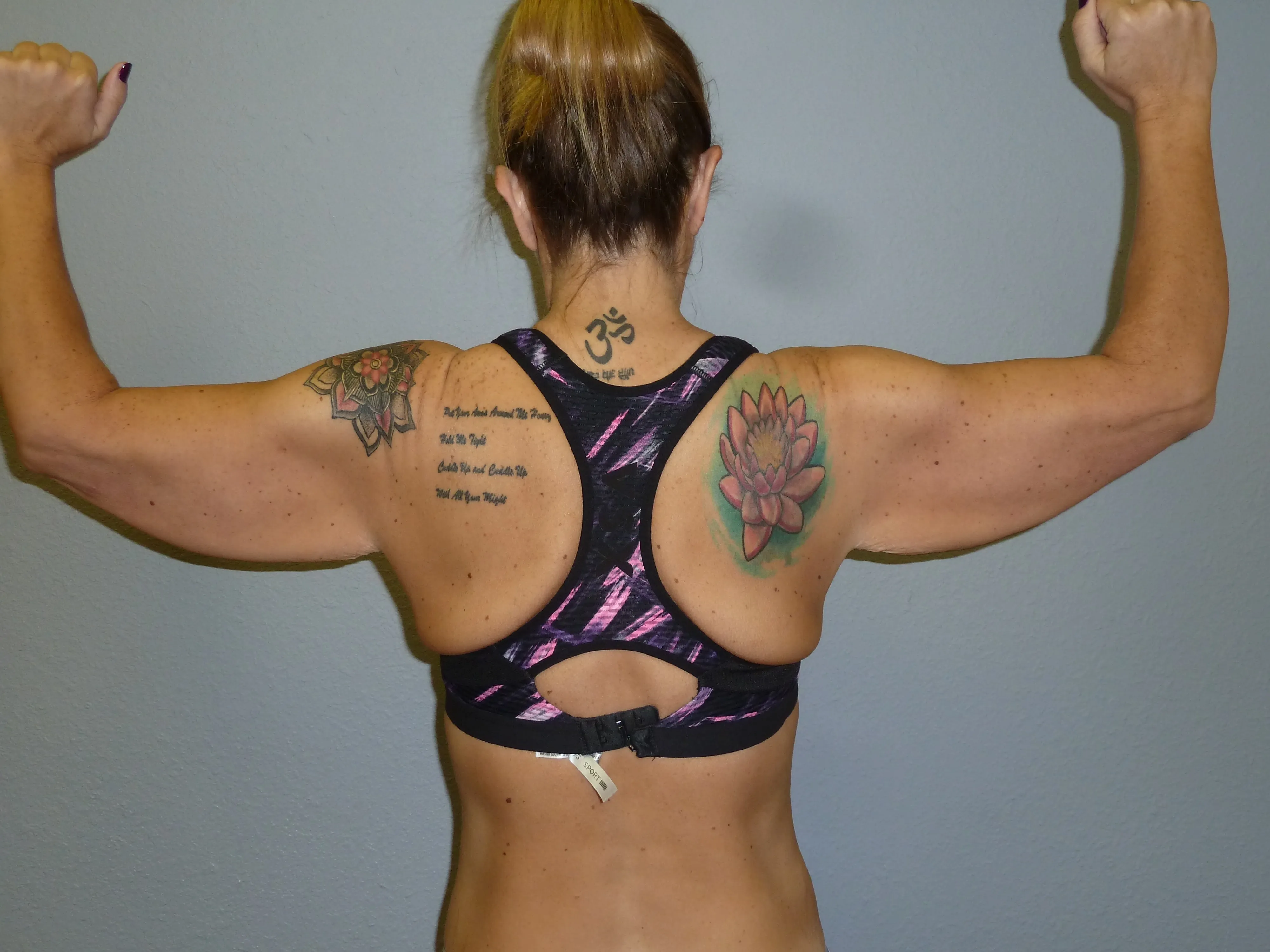 Arm Lift patient 1, before