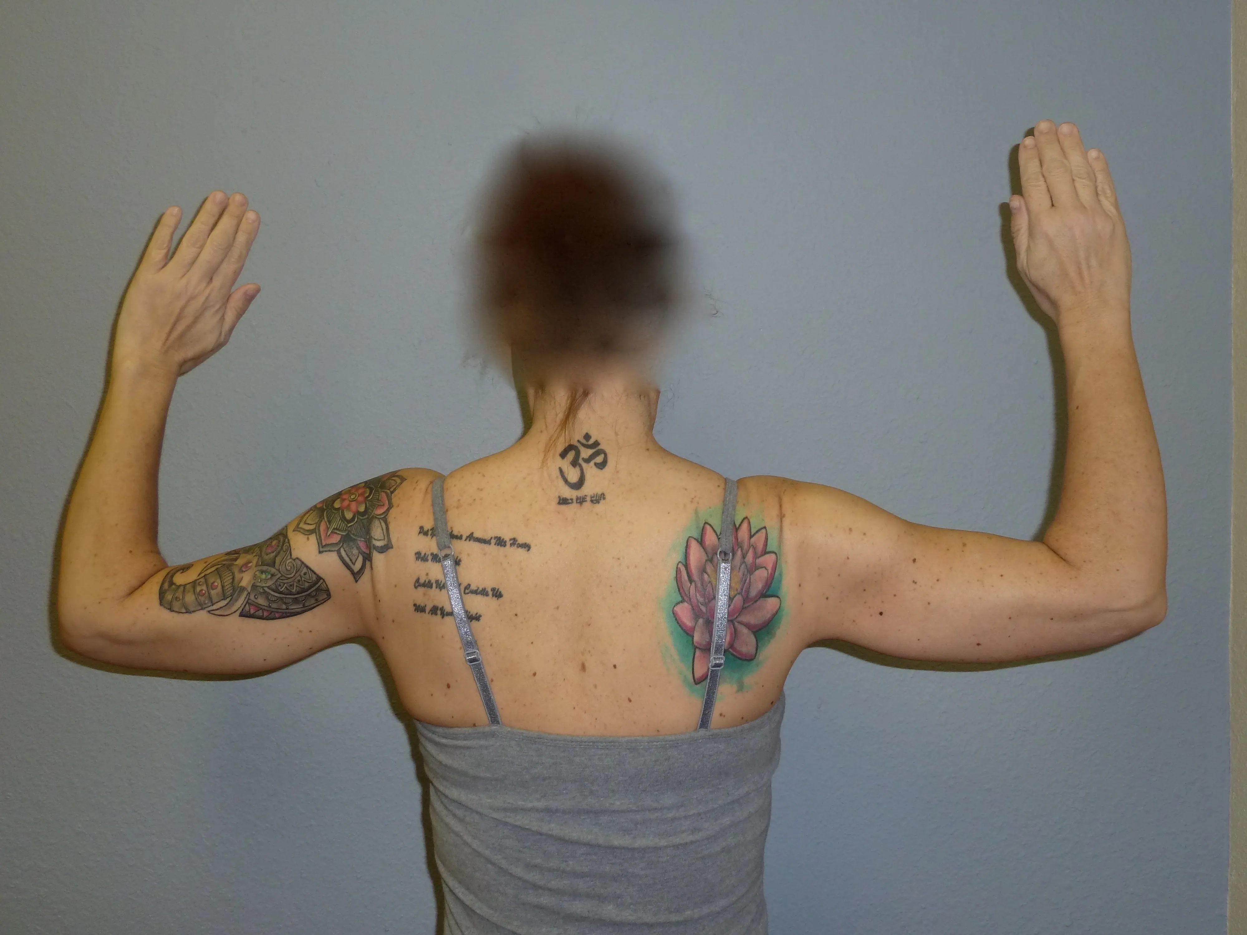 Arm Lift patient 1, after