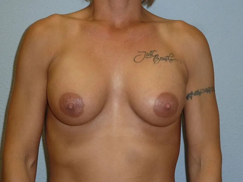 Breast Augmentation patient 33, after