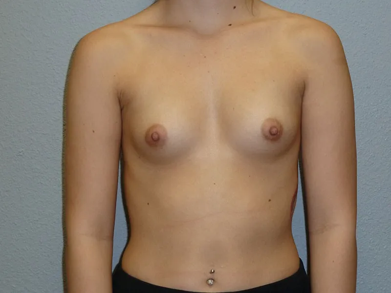 Breast Augmentation patient 32, before