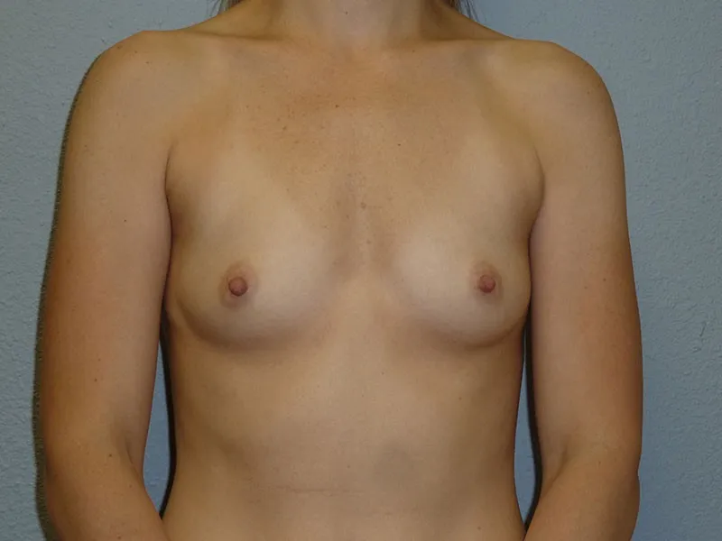 Breast Augmentation patient 31, before
